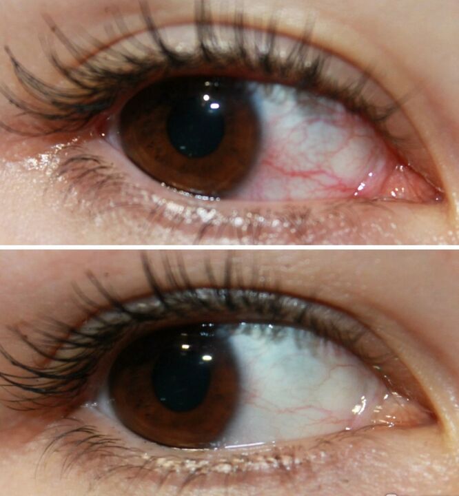 Ocuvit funciona muy rápido