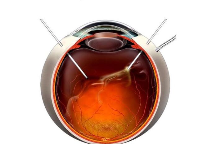 Vitrectomía una operación para restaurar la visión